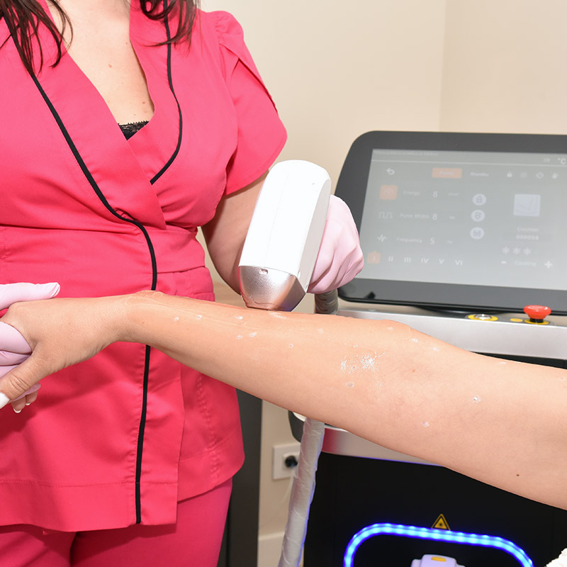 Ședință de epilare definitivă cu laser diodă la antebraț, la Epil VIP